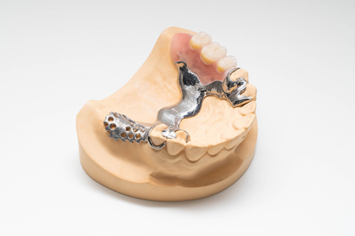 チタン合金製局部義歯